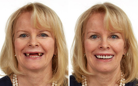 Snap-On-Smile