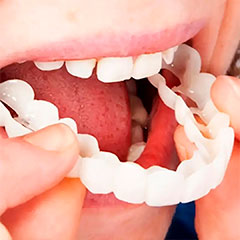 Snap-On-Smile
